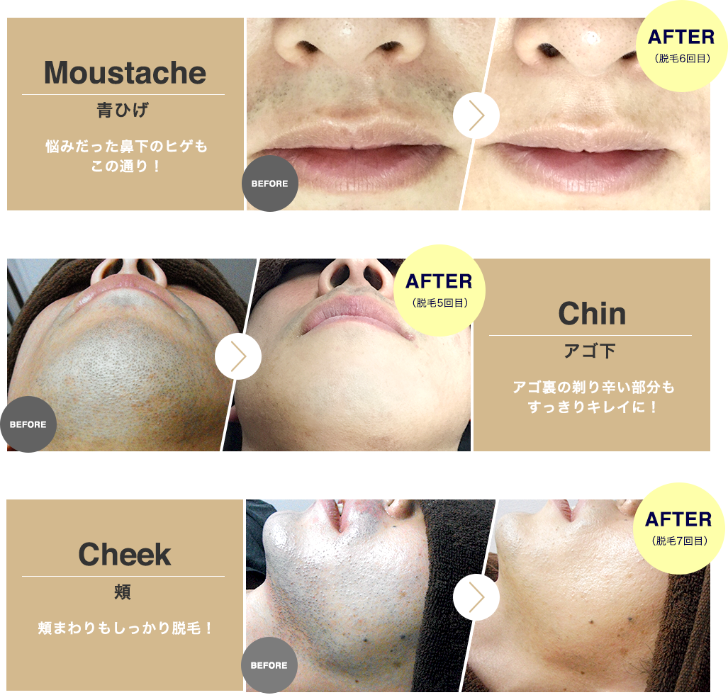 ヒゲ脱毛ビフォーアフターBefore After
